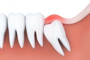 Tooth Extraction in Melrose MA | Wisdom Teeth Extraction