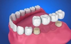 Dental Bridges in Melrose MA | Restorative Dentistry