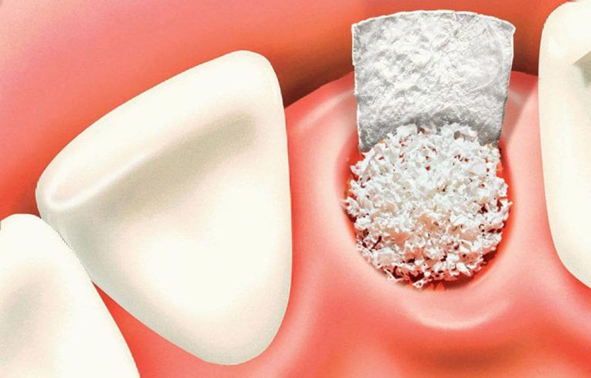 The best bone grafting services in Melrose Dental Group